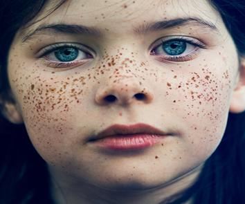 إزالة النمش في أسبوع